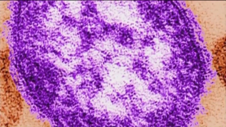 Georgia health officials report first measles case of 2026 in baby too young for vaccine