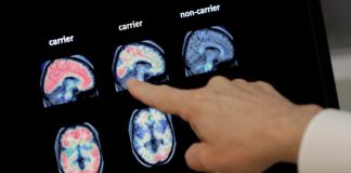 Researchers reverse advanced Alzheimer's in mice, paving way for new human trials