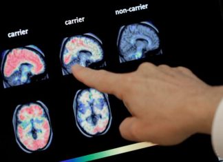 Researchers reverse advanced Alzheimer's in mice, paving way for new human trials