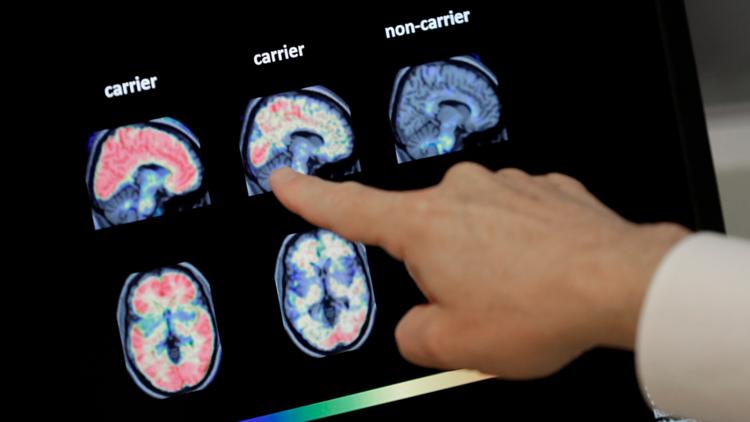 Researchers reverse advanced Alzheimer's in mice, paving way for new Researchers reverse advanced Alzheimer's in mice, paving way for new human trials