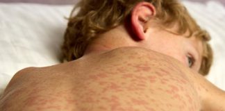 CDC: Nearly 1,000 US measles cases confirmed in first two months of 2026