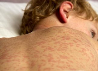 CDC: Nearly 1,000 US measles cases confirmed in first two months of 2026