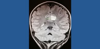 Georgia teen turns life-saving brain surgery into career helping kids