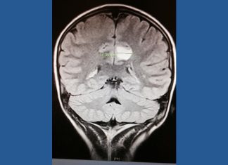 Georgia teen turns life-saving brain surgery into career helping kids