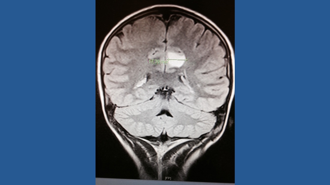 Georgia teen turns life-saving brain surgery into career helping kids