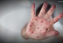 Measles spreading in the shadows; plus a cancer-fighting vaccine benefit you may not know and a gene therapy breakthrough