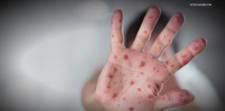 Measles spreading in the shadows; plus a cancer-fighting vaccine benefit you may not know and a gene therapy breakthrough