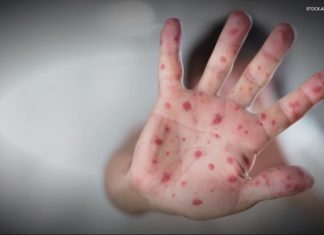 Measles spreading in the shadows; plus a cancer-fighting vaccine benefit you may not know and a gene therapy breakthrough