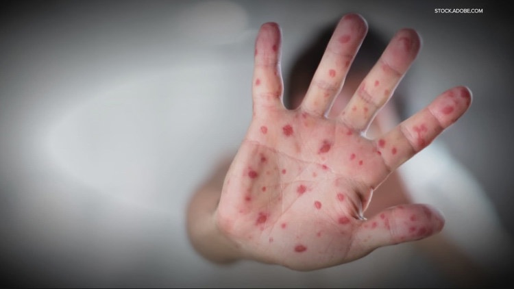 Measles spreading in the shadows; plus a cancer-fighting vaccine benefit you may not know and a gene therapy breakthrough
